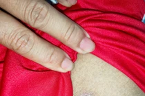 Mùa hè cẩn thận sốt mò gây viêm não và suy đa tạng