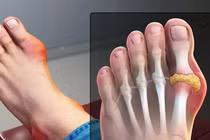 Chữa gút đơn giản với thực phẩm và thuốc nam quanh nhà