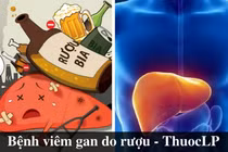 “Bí phương” cổ truyền chữa bệnh gan do rượu