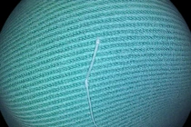 Gây mê lấy xương cá hóc vùng hạ họng