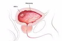 Bác sĩ chỉ rõ dấu hiệu và cách điều trị ung thư bàng quang