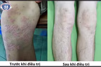 Vảy nến phủ khắp người vì viêm khớp