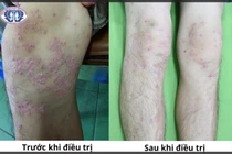 Vảy nến phủ khắp người vì viêm khớp