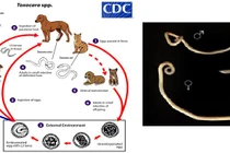 Đau bụng, sút cân đi khám bất ngờ phát hiện Abcess gan do giun đũa chó