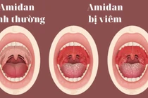 Bác sĩ chỉ rõ biến chứng và đối tượng cần cắt viêm amidan