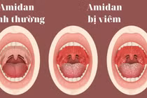 Bác sĩ chỉ rõ biến chứng và đối tượng cần cắt viêm amidan