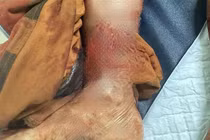 Chó nhà cắn đứt rời chân chủ nguy kịch