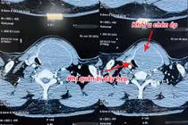 Khối u vỡ chèn ép khí quản bệnh nhân