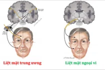 Mới 2 tuổi đã bị liệt mặt vì sự chủ quan với thời tiết lạnh