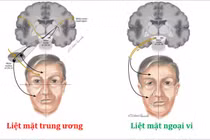 Mới 2 tuổi đã bị liệt mặt vì sự chủ quan với thời tiết lạnh