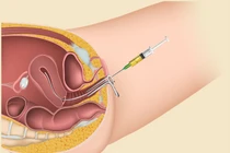 Điều kiện để tiến hành thụ tinh nhân tạo