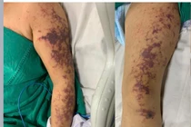 Ăn lòng lợn, người phụ nữ 59 tuổi sốc nhiễm khuẩn do mắc liên cầu lợn