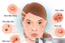7 nguyên tắc giúp trị mụn trứng cá hiệu quả