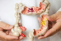 Sự nguy hiểm của viêm đại tràng nhiều người không biết