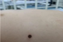 Lần đầu tiên tại miền Nam: Cứu sống bé gái nguy kịch vì bệnh sốt mò 