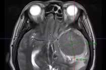 Đau đầu bất ngờ phát hiện u màng não khổng lồ ăn sâu vào não