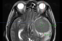 Đau đầu bất ngờ phát hiện u màng não khổng lồ ăn sâu vào não