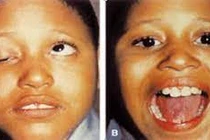 Mắt bị kéo ngược khi nhai hoặc nói, bệnh gì?