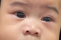 Bác sĩ chỉ rõ dùng lá, tinh dầu xông đau mắt đỏ gây hỏng mắt