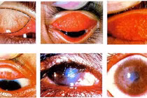 Điều bắt buộc phải chú ý để tránh biến chứng khi đau mắt sau mưa lũ