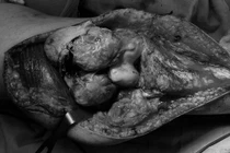 Thay toàn bộ khớp gối vì u tế bào tái phát khổng lồ lần 3