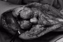 Thay toàn bộ khớp gối vì u tế bào tái phát khổng lồ lần 3