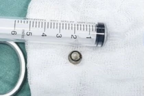 Viên pin tròn rơi vào phổi, trẻ 8 tháng đe dọa ngạt thở