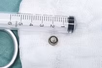 Viên pin tròn rơi vào phổi, trẻ 8 tháng đe dọa ngạt thở