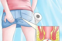 Nguy cơ bệnh nguy hiểm nếu chủ quan với ngứa hậu môn