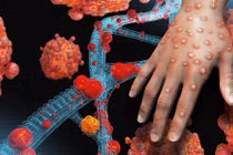 TP HCM đã ghi nhận 4 trường hợp mắc bệnh Đậu mùa khỉ