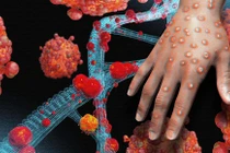 TP HCM đã ghi nhận 4 trường hợp mắc bệnh Đậu mùa khỉ