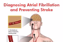 Gia tăng người đột quỵ do rung nhĩ