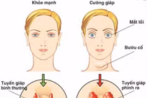 Basedow xuất hiện sau stress có thể tự khỏi