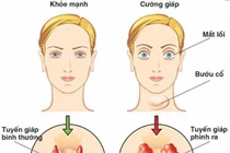 Basedow xuất hiện sau stress có thể tự khỏi