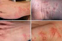 Bác sĩ điểm mặt các bệnh da liễu hay gặp khi vào hè
