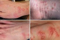 Bác sĩ điểm mặt các bệnh da liễu hay gặp khi vào hè