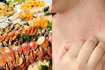 Tưởng con dị ứng do ăn hải sản, nào ngờ sốc phản vệ nguy kịch