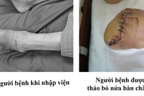 Cụ ông phải tháo bỏ nửa bàn chân vì chủ quan