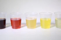 Đái ra máu cảnh báo bệnh gì?