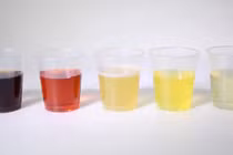 Đái ra máu cảnh báo bệnh gì?