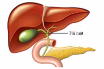 Bị sỏi túi mật không điều trị cụ bà 75 tuổi bị hội chứng Mirizzi