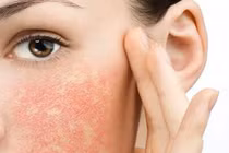 Chuyên gia mách cách xử lý dị ứng mỹ phẩm