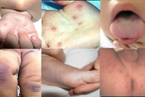Bộ y tế yêu cầu cả nước phòng chống bệnh tay chân miệng