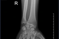 Đau cổ tay kéo dài hình thành khớp giả xương thuyền