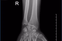 Đau cổ tay kéo dài hình thành khớp giả xương thuyền