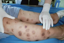 Tiêm canxi tại nhà, bệnh nhân 43 tuổi bị hoại tử khắp tay chân