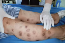 Tiêm canxi tại nhà, bệnh nhân 43 tuổi bị hoại tử khắp tay chân