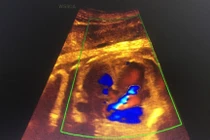 Không khám sàng lọc, phát hiện con bị down lúc sắp sinh