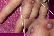 Phân biệt bệnh đậu mùa khỉ với tay chân miệng