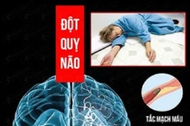 Nhận biết sớm thể đột quỵ não tránh biến chứng nguy hiểm